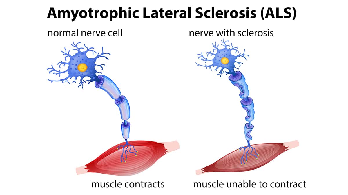 Amyotrophic Lateral Sclerosis