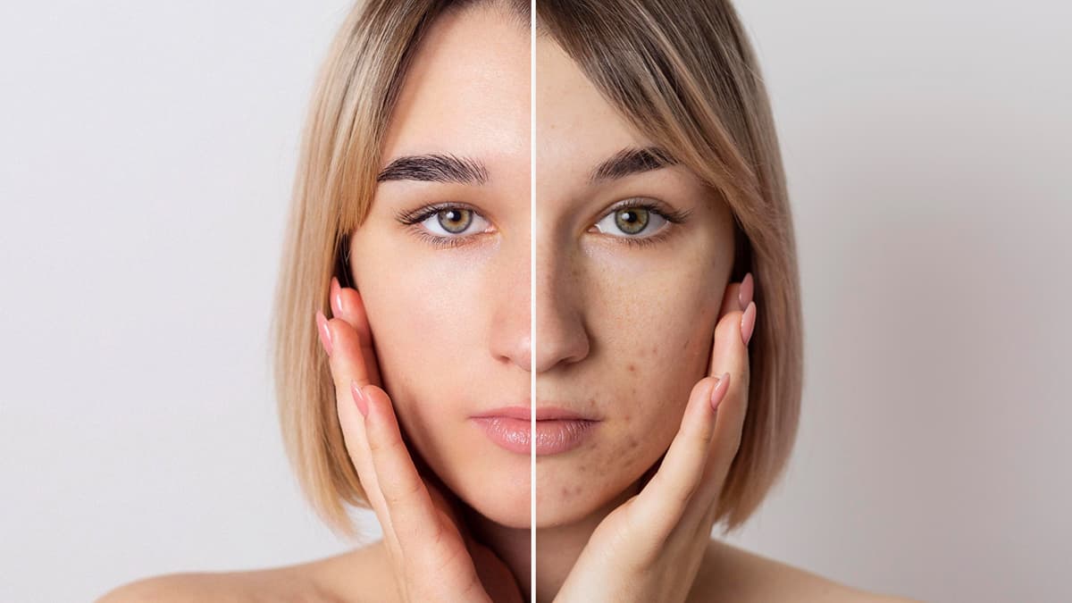 Anti-Aging and Acne