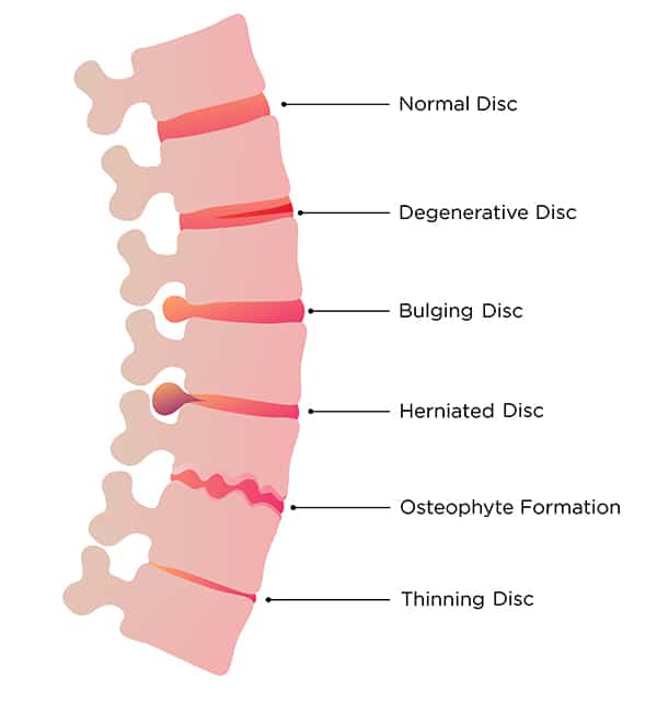 Degenerative Disc Disease