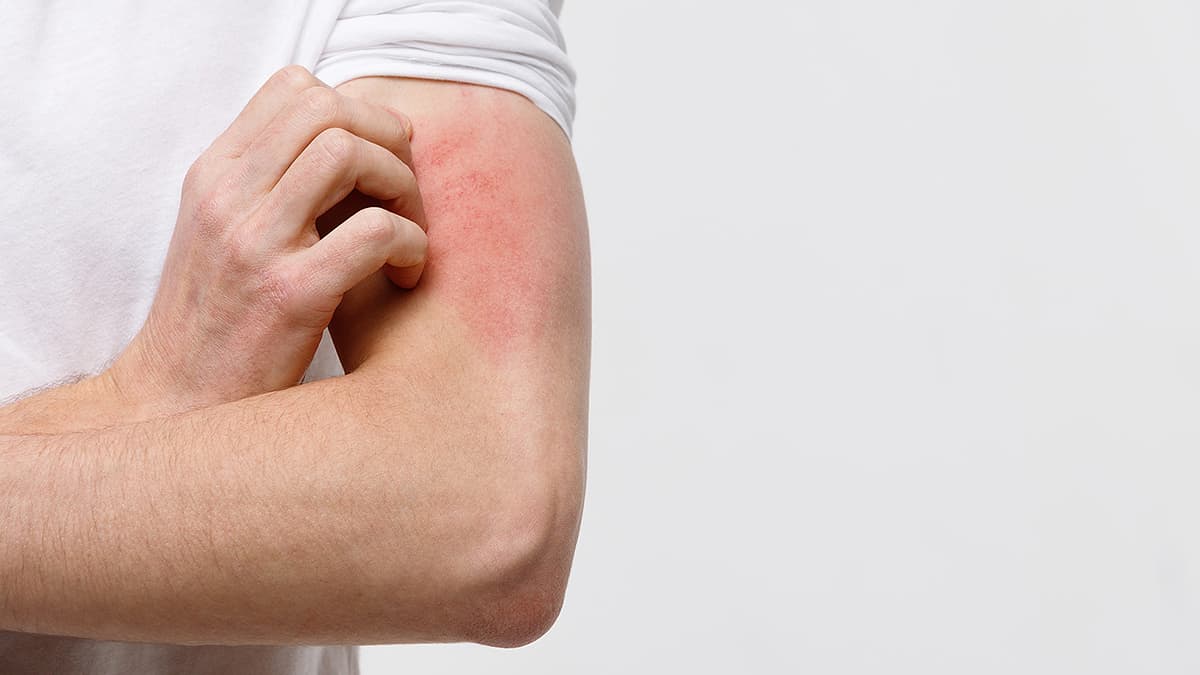 Hives and Rashes