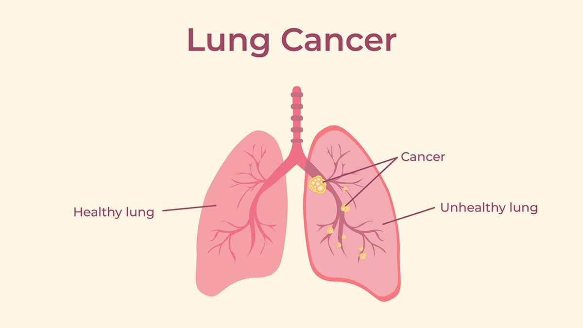 Illustration showing lung cancer