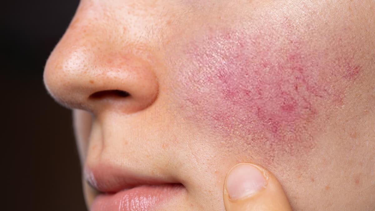 Treatments for Rosacea