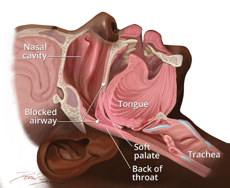 Anatomy of mouth showing obstructive sleep apnea