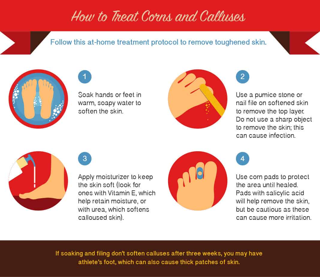 How To Prevent Calluses & Corns - Tread Labs