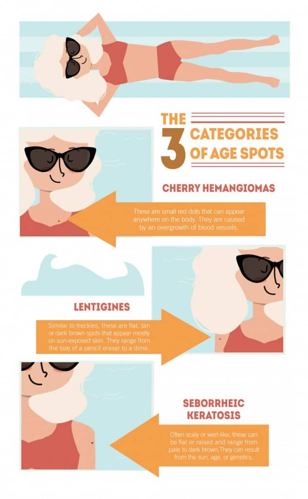 The 3 Categories of Age Spots