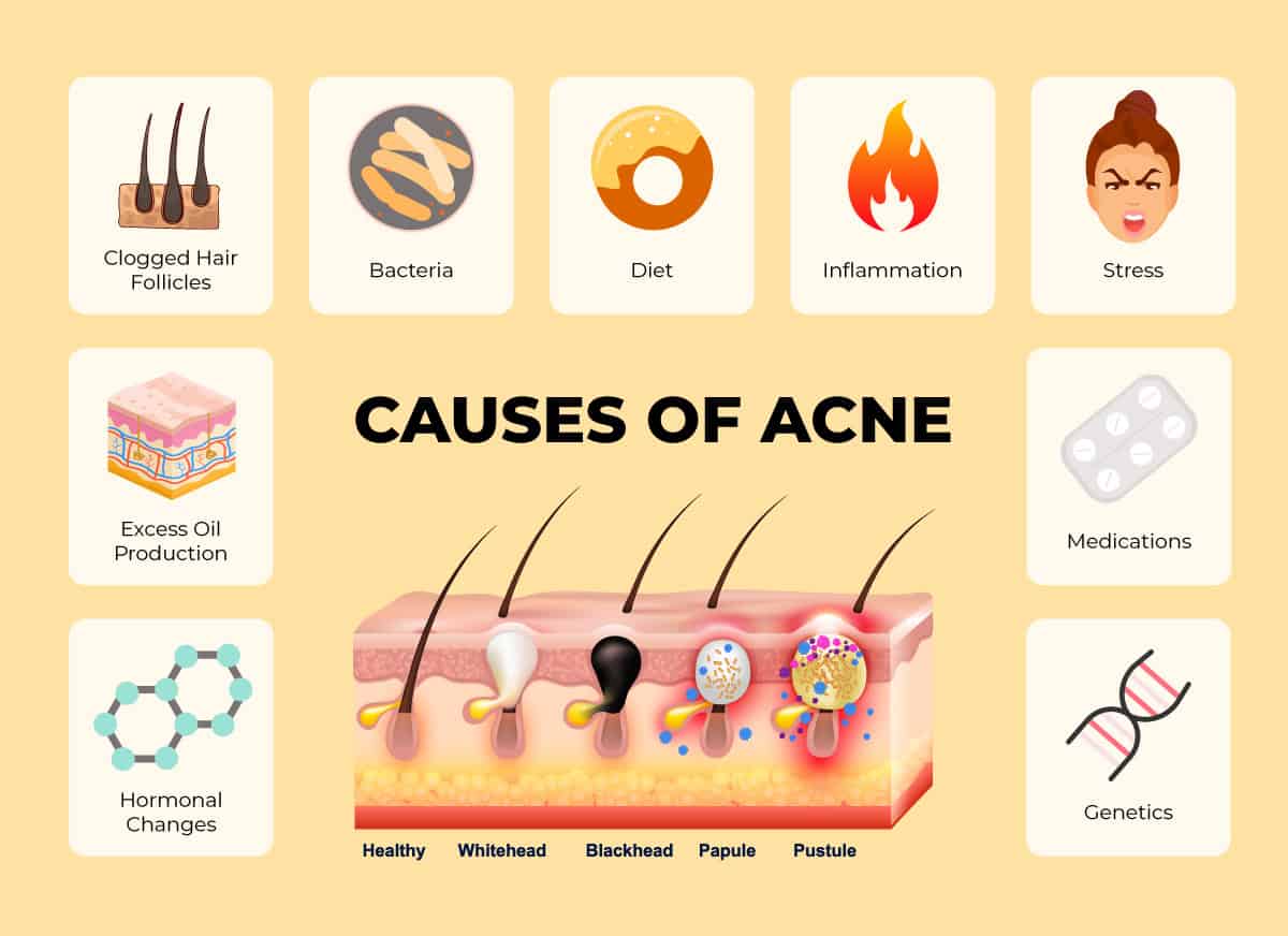 Causes of acne infographic
