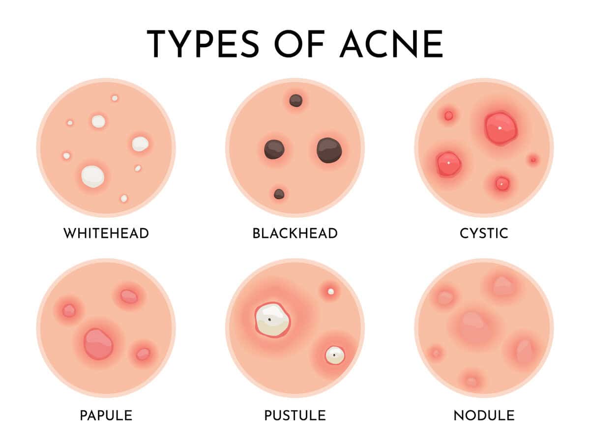 Types of acne infographic