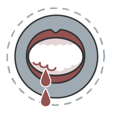 Bleeding from the mouth or gums