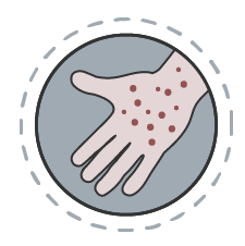 Shingles infection