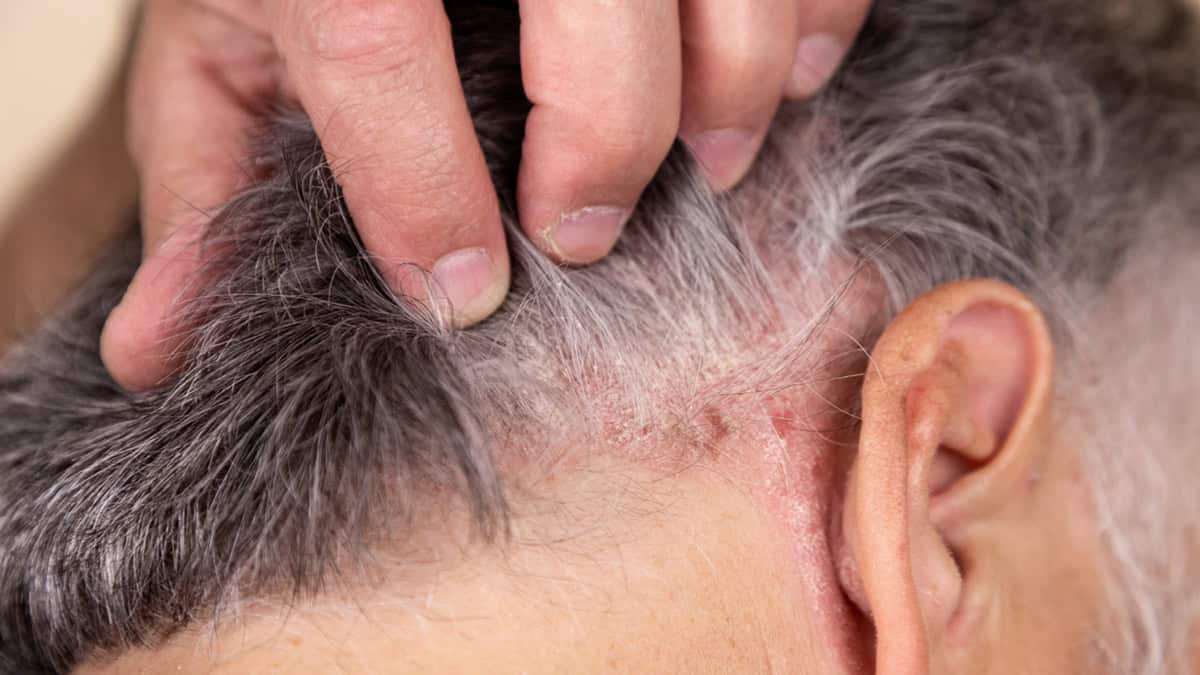 Person suffering from seborrheic dermatitis