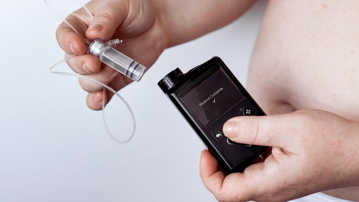 Choosing the Best Insulin Pumps for Type 1 Diabetes