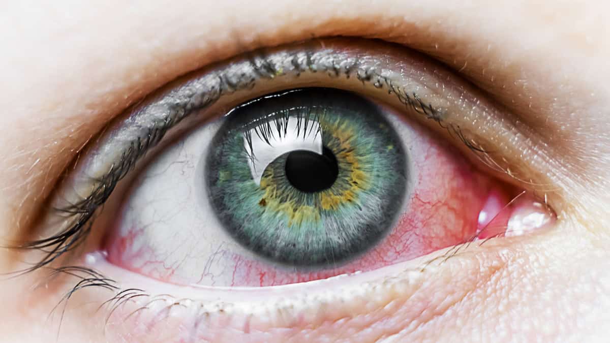 Why is Miebo So Expensive? Eye Drop Cost Explained