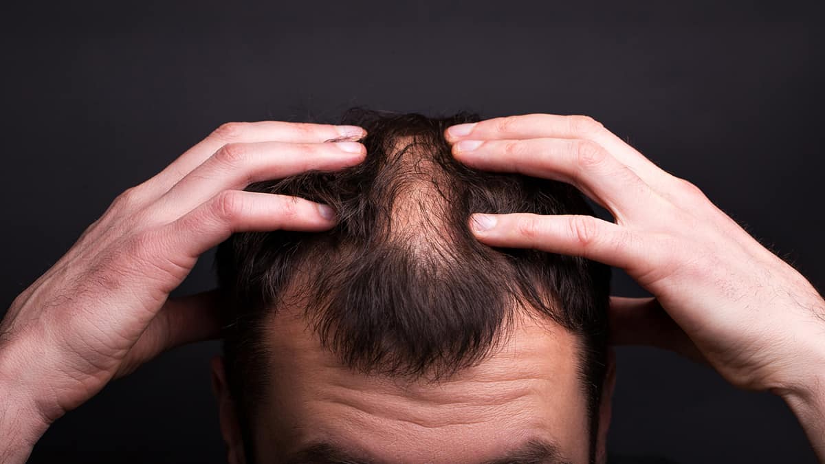 Special Features - Saving Money on Prescription Medication for Hair Loss