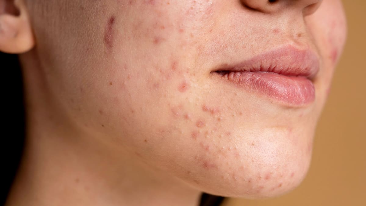 Popular Acne Medication