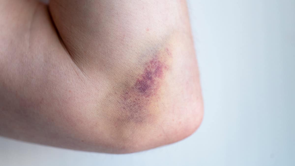 Person with a bruise on her arm