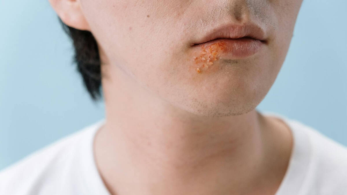 Valacyclovir (Valtrex) vs Acyclovir for Cold Sores & Shingles