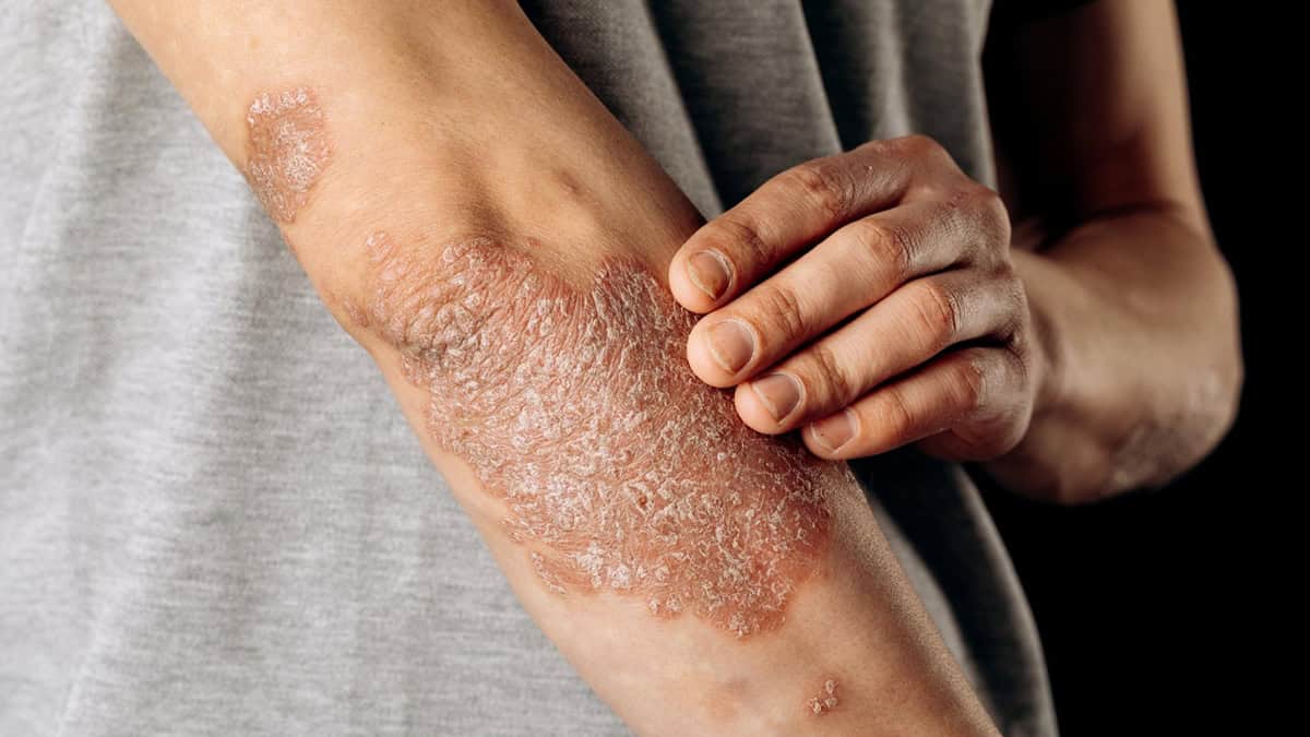 All Vtama Cream Questions Answered: Uses, Indications, & More
