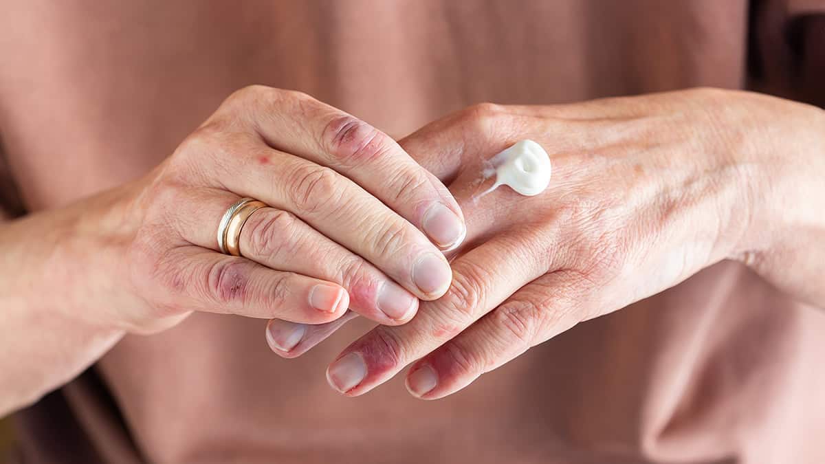 Zoryve Cream Questions Answered: Side Effects, Generic, & More